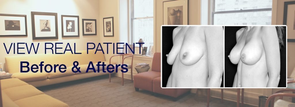 Before and after breast augmentation results shown.
