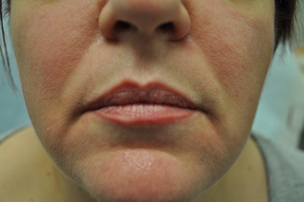 Close-up of a person's lips and lower face with a skin condition.