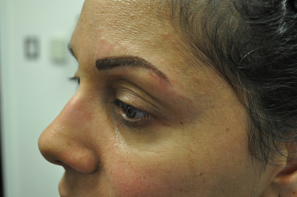 Close-up of a woman's face showing a swollen eyebrow area.