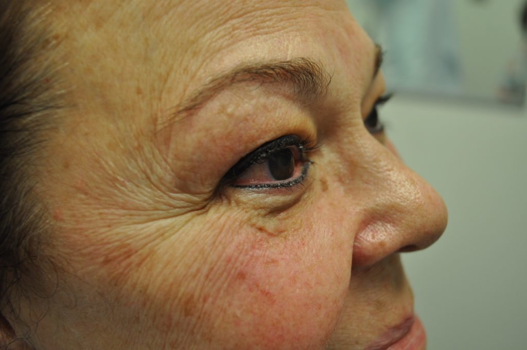 Close-up of an older woman's face showing wrinkles and skin texture.