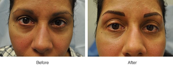 Before and after images showing reduced under-eye dark circles.