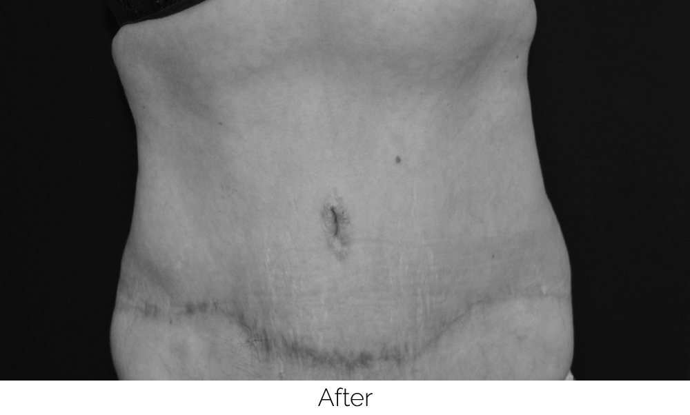 Close-up of a healed lower abdomen with a faint surgical scar.
