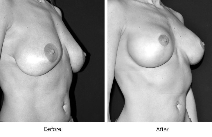 Before and after images of breast augmentation surgery.