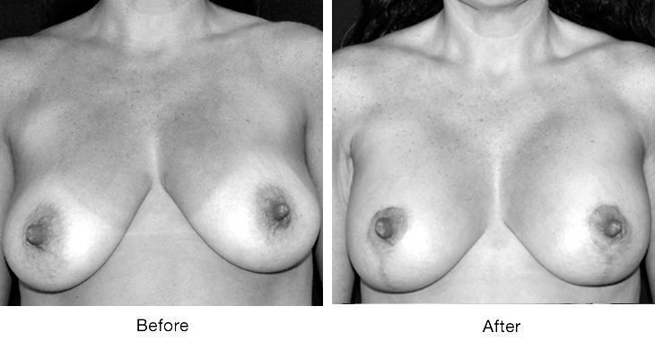 Black and white before and after photos of a breast reduction surgery.