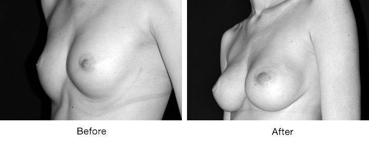 Before and after breast augmentation surgery showing enhanced breast size and shape.