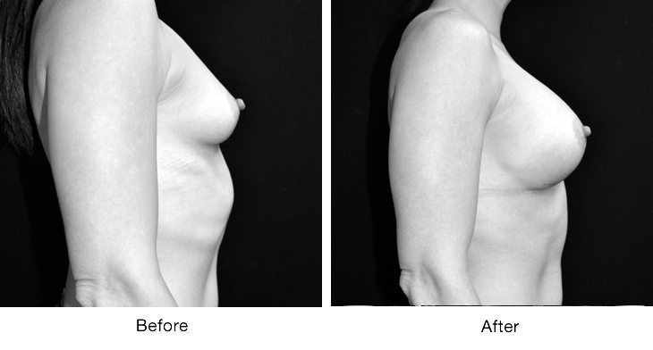 Side-by-side before and after photos showing breast augmentation results.