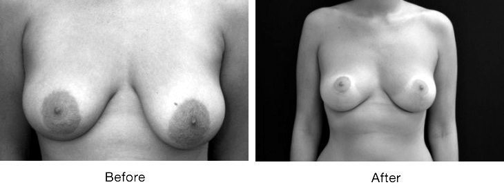 Before and after breast reconstruction surgery in black and white.