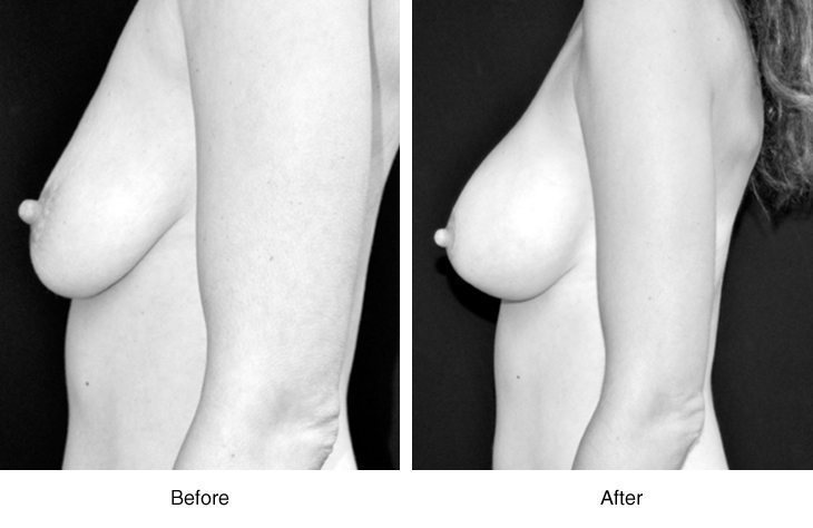 Before and after images of breast augmentation results.