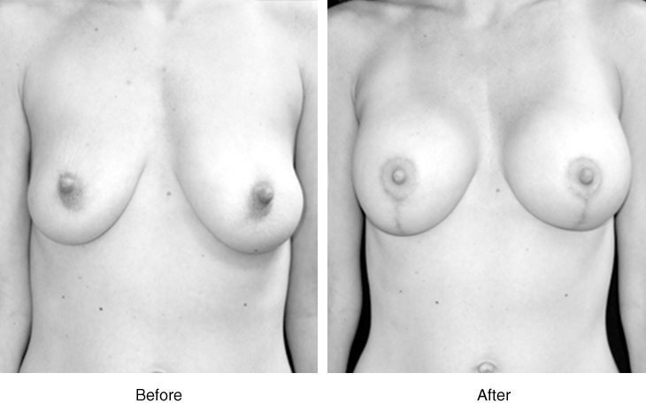 Before and after breast augmentation surgery showing enhanced breast shape.