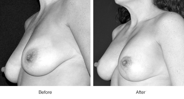 Before and after images of breast reconstruction surgery.