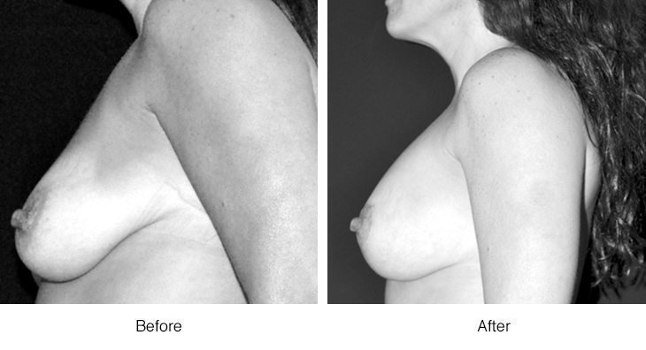 Before and after photos of a breast augmentation.
