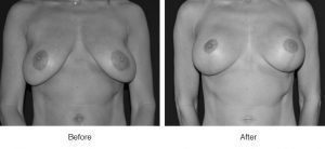 Breast augmentation before and after comparison