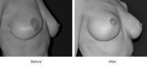 Breast surgery before and after side views