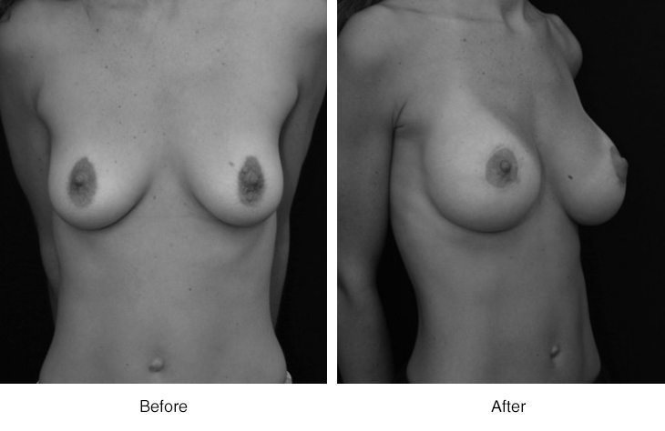 Before and after breast augmentation surgery showing enhanced volume and shape.