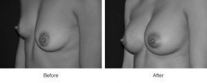 Before and after breast augmentation results