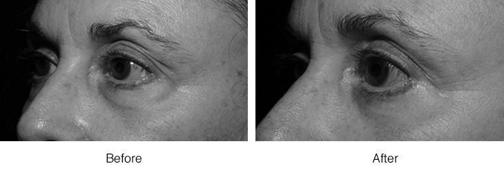 Close-up before and after images of a person's facial skin showing texture improvement.