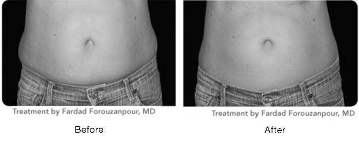 Before and after images showing reduced abdominal fat after treatment.