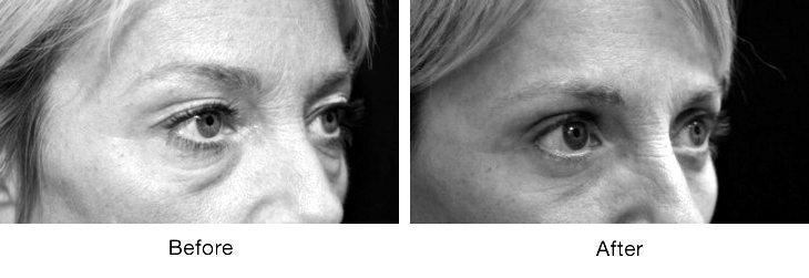 Close-up comparison of facial skin around the eye before and after treatment.