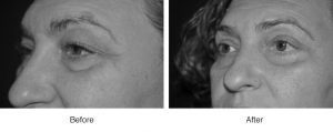 Close-up comparison of a person's face before and after treatment.