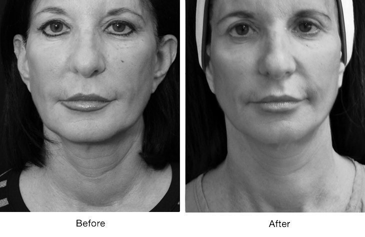 Before and after black-and-white portrait comparison.