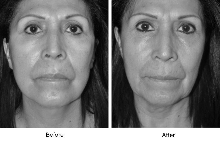 Before and after facial treatment showing reduced wrinkles and improved skin tone.