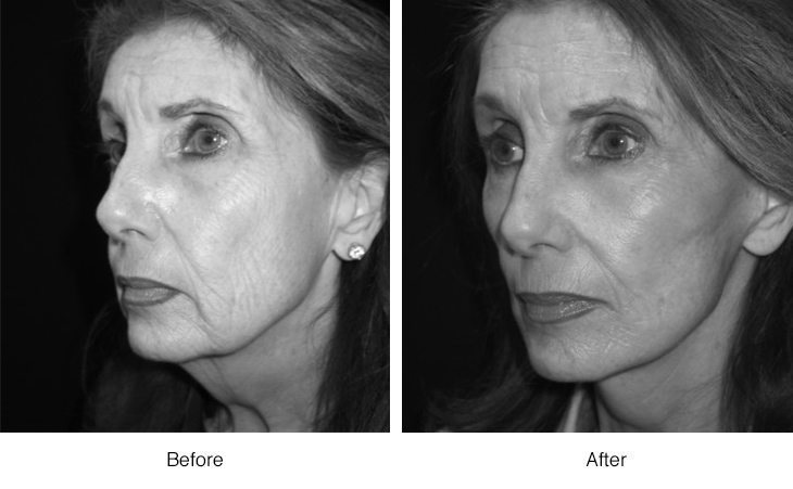 Side-by-side black and white photos showing a woman's facial transformation before and after a cosmetic procedure.