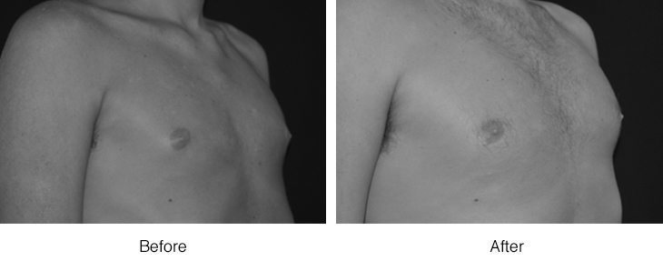 Before and after photos of a chest showing muscle definition improvement.