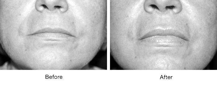 Before and after images showing improved skin texture and reduced acne scars.