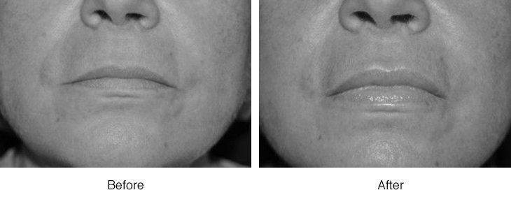 Side-by-side comparison of facial skin showing reduced wrinkles after treatment.