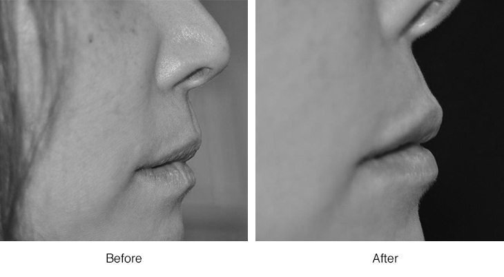 Side-by-side black and white close-ups showing before and after lip enhancement.