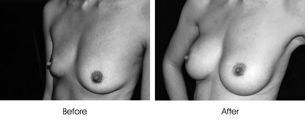 Before and after breast augmentation surgery photos.