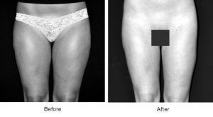 Before and after thigh lift surgery photos showing improved contour.