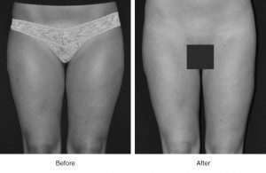 Before and after comparison of thigh appearance in a grayscale image.