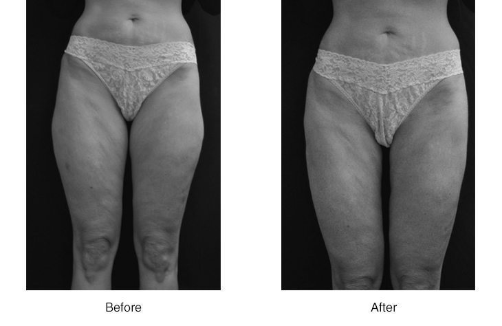 Before and after images showing thigh contour improvement.