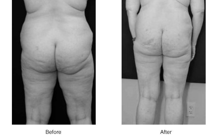 Before and after images of a person's legs and buttocks showing physical changes.