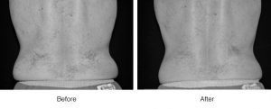Before and after comparison showing reduced back fat or skin tightening.