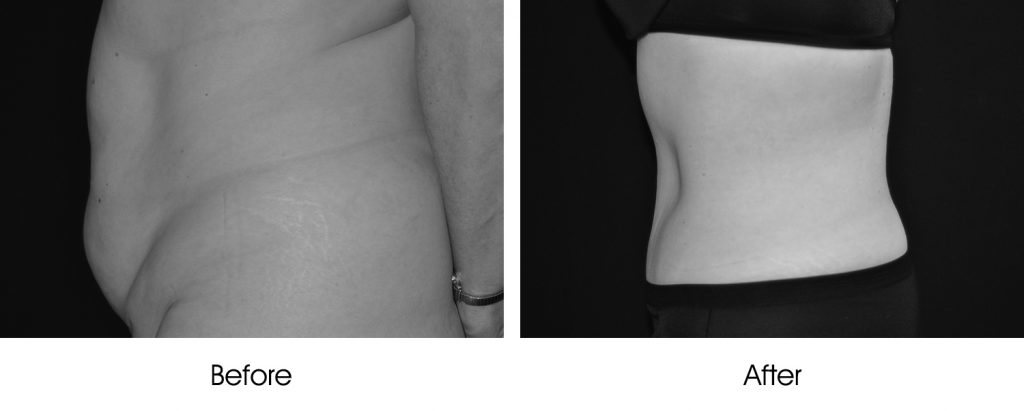 Before and after images showing body contouring results.
