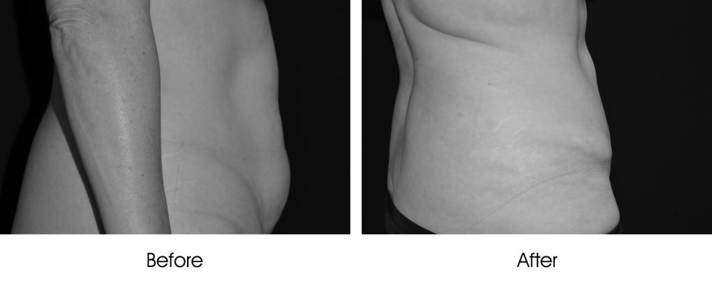 Side-by-side black and white images showing body contour before and after reduction.