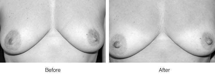 Before and after breast surgery showing nipple reconstruction.