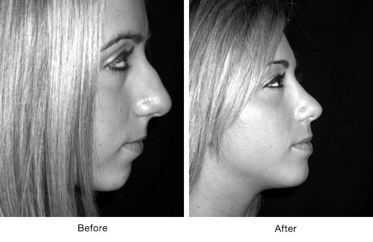 Side-by-side profile of a woman before and after rhinoplasty surgery.