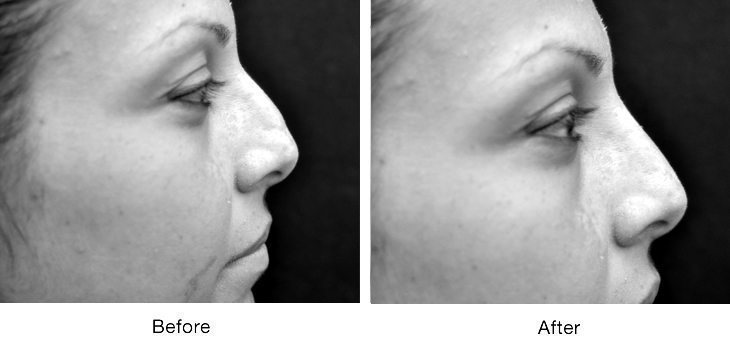 Side-by-side before and after profiles showing a nose transformation.
