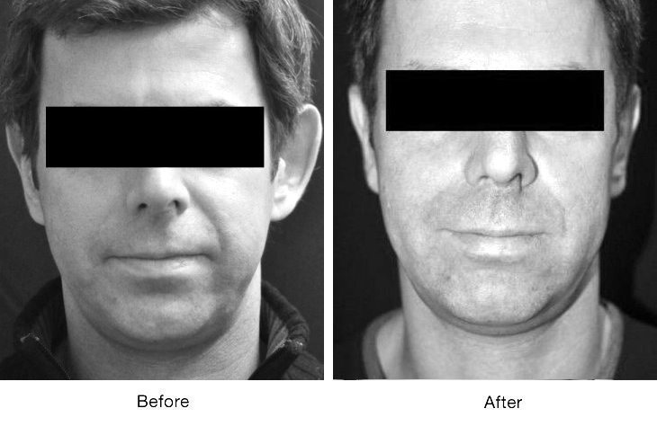 Before and after photos showing facial skin improvement.