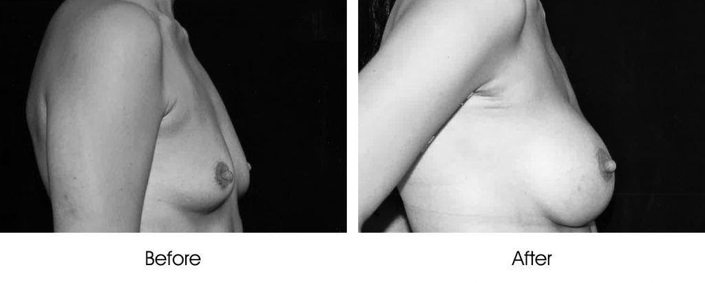 Black and white side-by-side portraits of a woman's upper torso and arm.