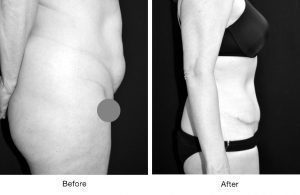 Before and after side views showing body transformation.