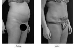 Before and after photos of a tummy tuck surgery showing a flatter abdomen and surgical scar.