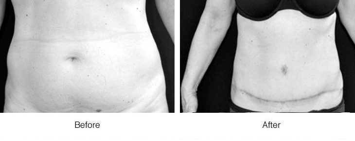 Before and after photos showing arm fat reduction.