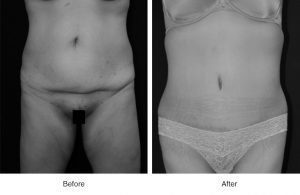 Before and after photos of abdominal scar treatment.