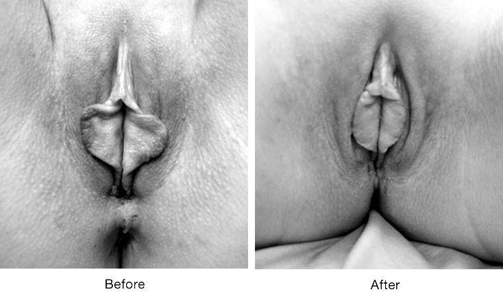 Before and after images showcasing labiaplasty results.
