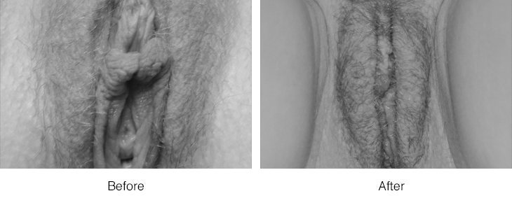 Black and white close-up images of human armpits.