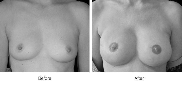 Before and after breast augmentation comparison.